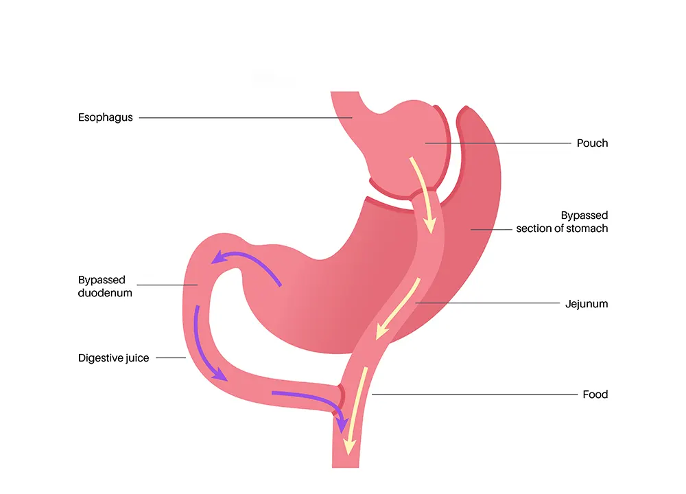 Gastric Bypass