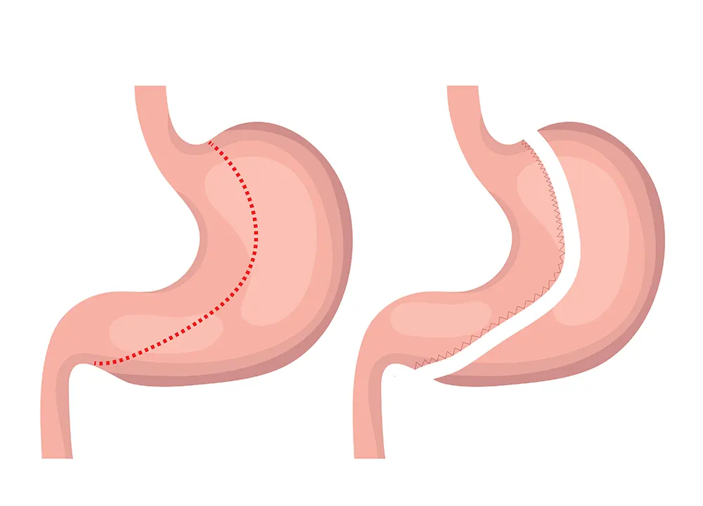 Gastric Sleeve