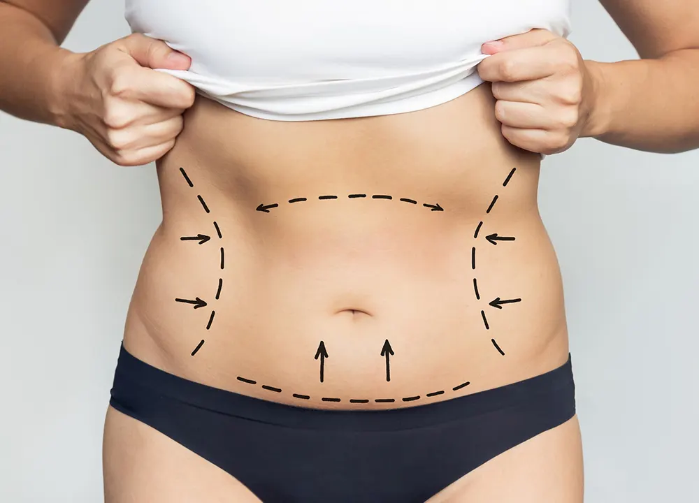 Liposuction