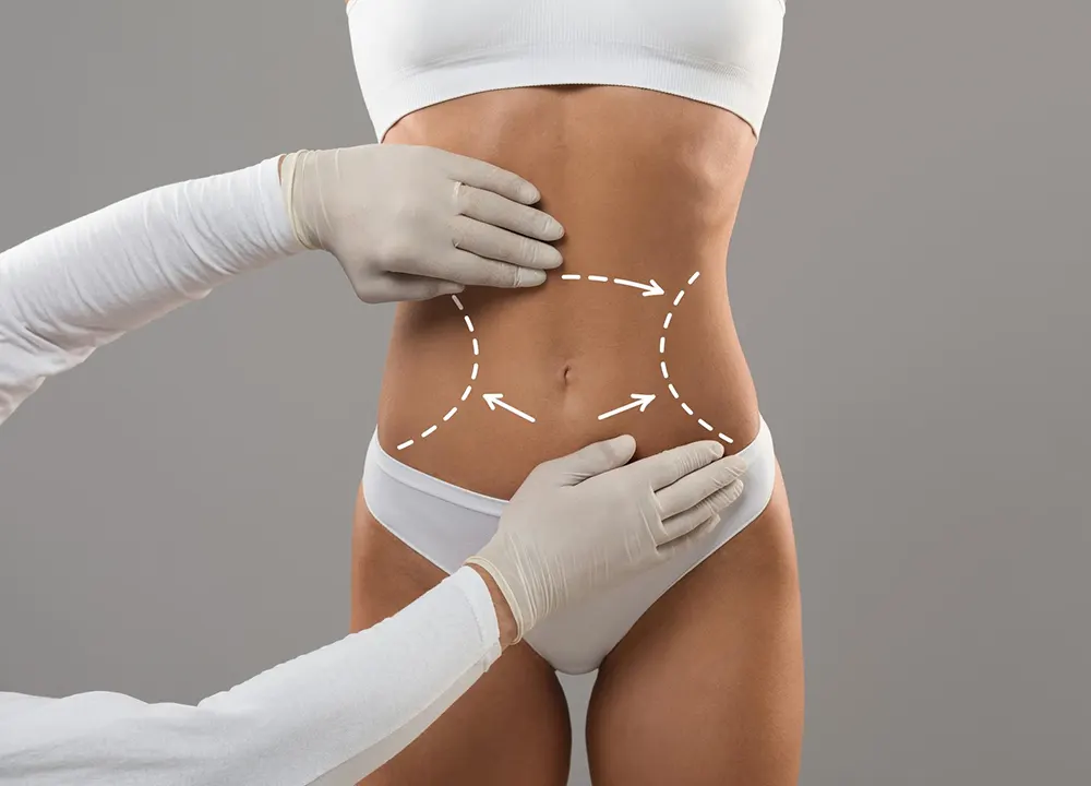 Tummy Tuck Surgery