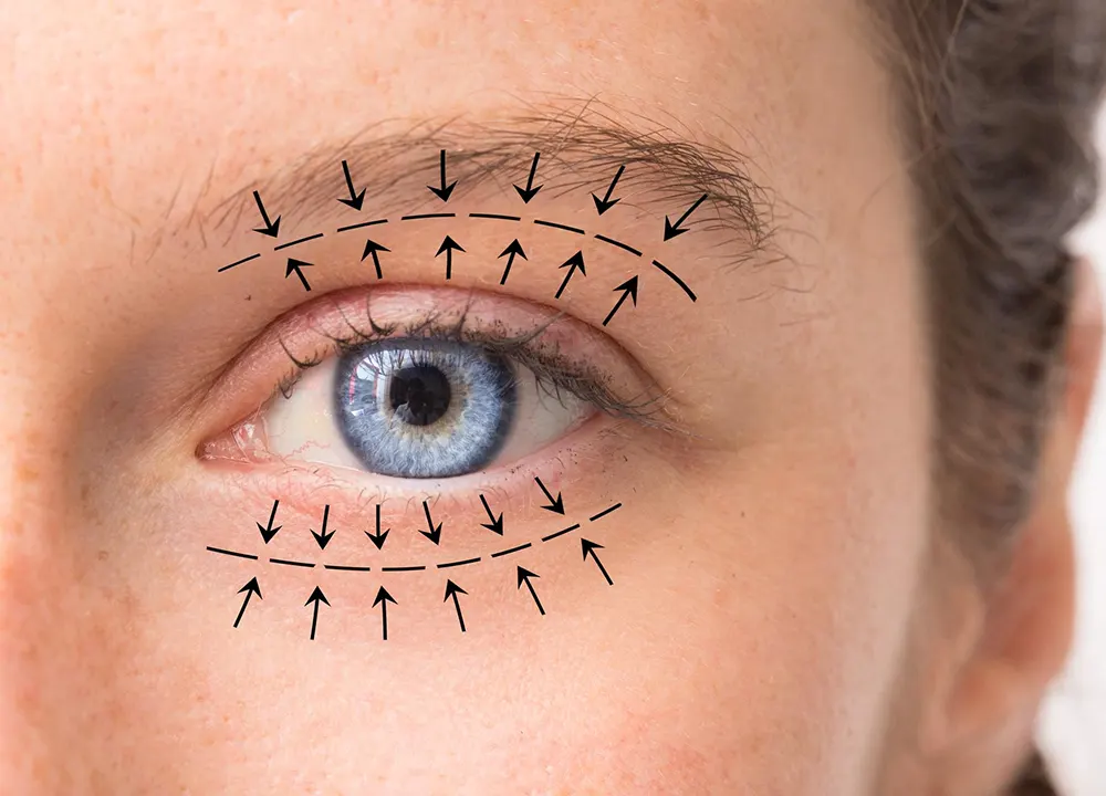 What is Eyelid Aesthetic Surgery (Blepharoplasty)?