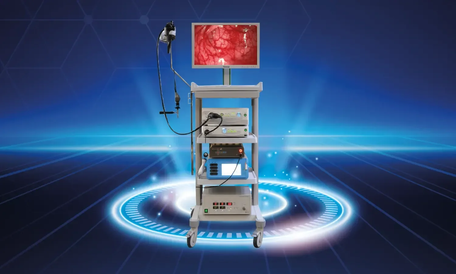 Endoscopic Laser Stone Treatment